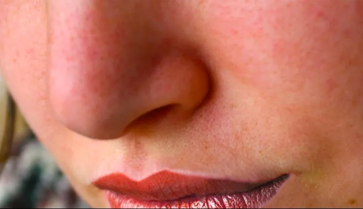 What Is Rosacea