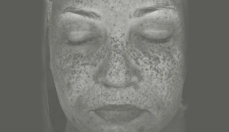Filtered image showing discoloration in a woman's skin on her face.