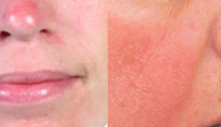 Two close up images of red, dry skin indicating sensitive and sensitized skin.