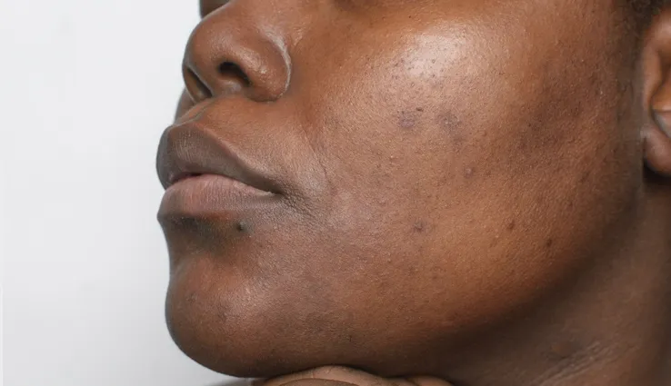 A close-up of a woman's face showing discoloration. 