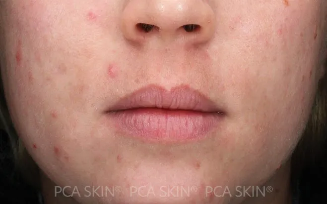 Acne Gel Before